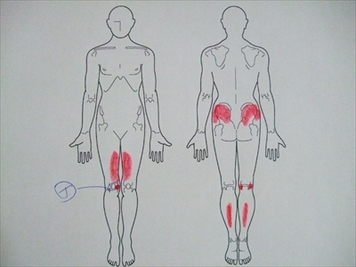 膝の痛み,内側側副靭帯損傷