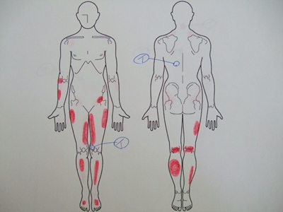膝の痛み、背中の痛み