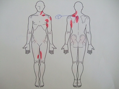 肩の痛み、背中の痛み