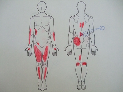 腰痛、ぎっくり腰