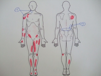 首の痛み、肩の痛み、腰痛