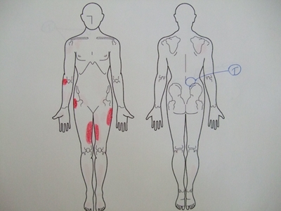 腰痛、ぎっくり腰