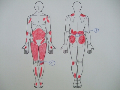 腰痛、ぎっくり腰