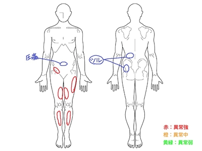 ぎっくり腰、腰痛