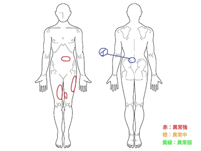 ぎっくり腰、腰痛