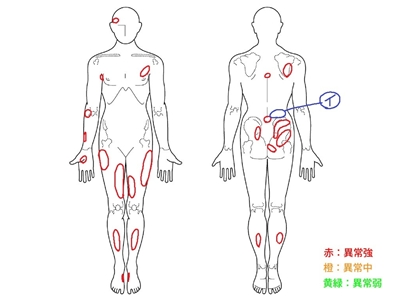 ぎっくり腰、腰痛