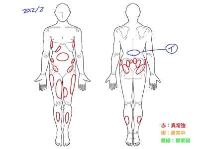 ぎっくり腰、腰痛