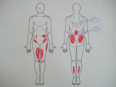 腰のハリ,腰痛